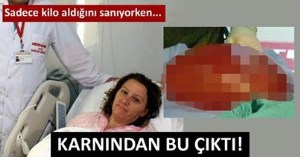 Bu Kadının Karnından 10 kilogramlık kist çıktı