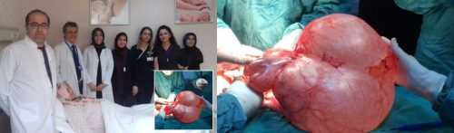 Çorum'da Kadının karnından 13 kiloluk kitle çıktı