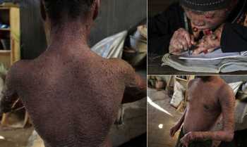 YILAN ÇOCUK 41 SAAT'DE DERİ DEĞİŞTİRİYOR