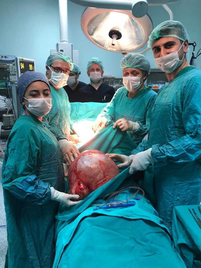 Çorum'da Kadının karnından 13 kiloluk kitle çıktı