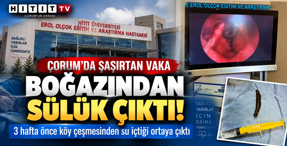 Çorum’da Şaşırtan Vaka Boğazından Sülük Çıktı